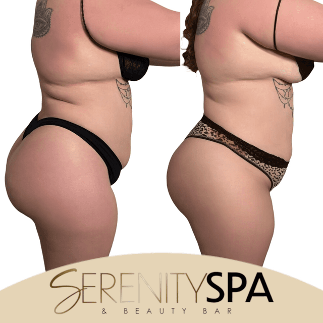 Snatch Me Up Combo - 4 Sessions at Serenity Spa & Beauty Bar in Warwick, RI