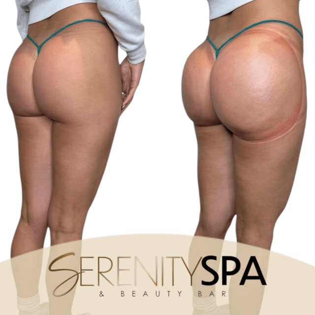 BBL/Hip Enhancement - 4 Sessions at Serenity Spa & Beauty Bar in Warwick, RI